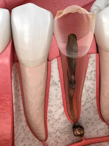 Zahnwurzelentzündung: Alles über Symptome und Behandlung der Pulpitis